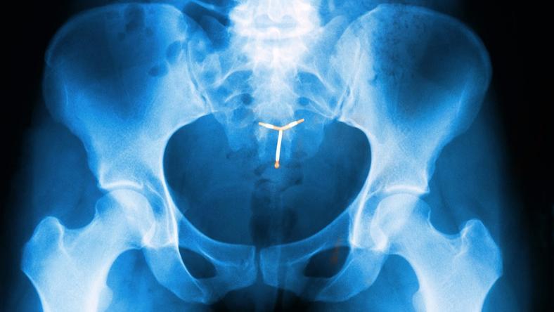 一部上“环”主导的中国女性避孕史